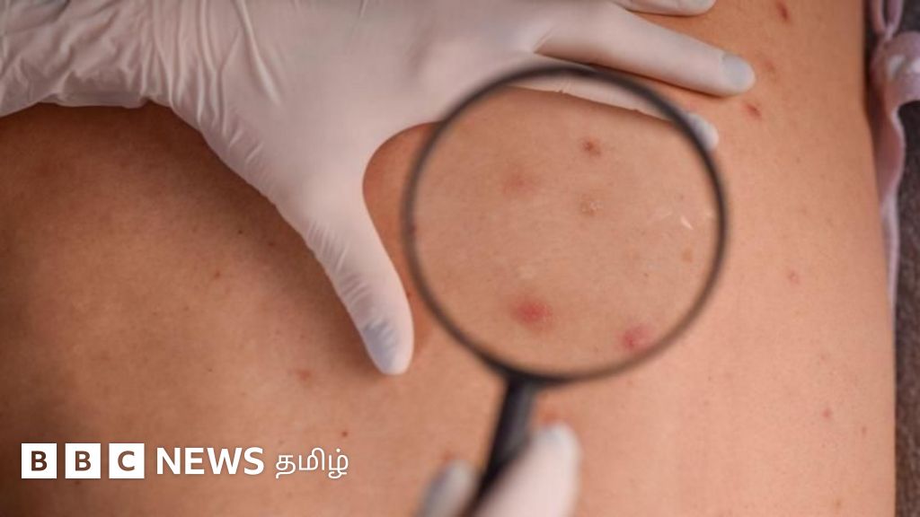 தோல் புற்றுநோய் யாருக்கெல்லாம் வரலாம்? ஆரம்ப அறிகுறிகளை இனங்கண்டு குணப்படுத்தும் வழிகள்