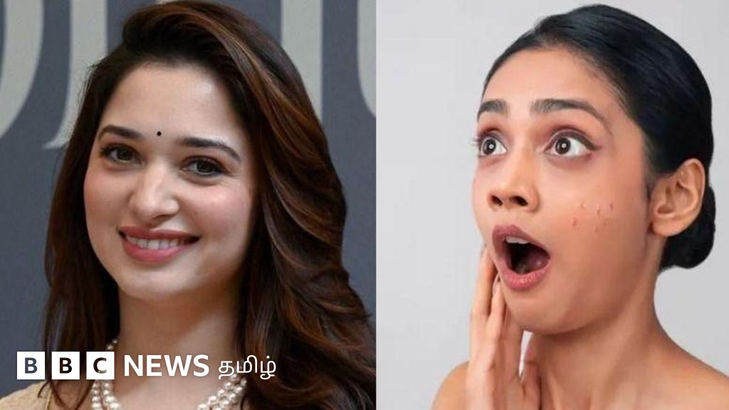 உமிழ்நீரை தடவினால் முகப்பரு குணமாகுமா? தமன்னா கூற்று பற்றிய அறிவியல் உண்மை