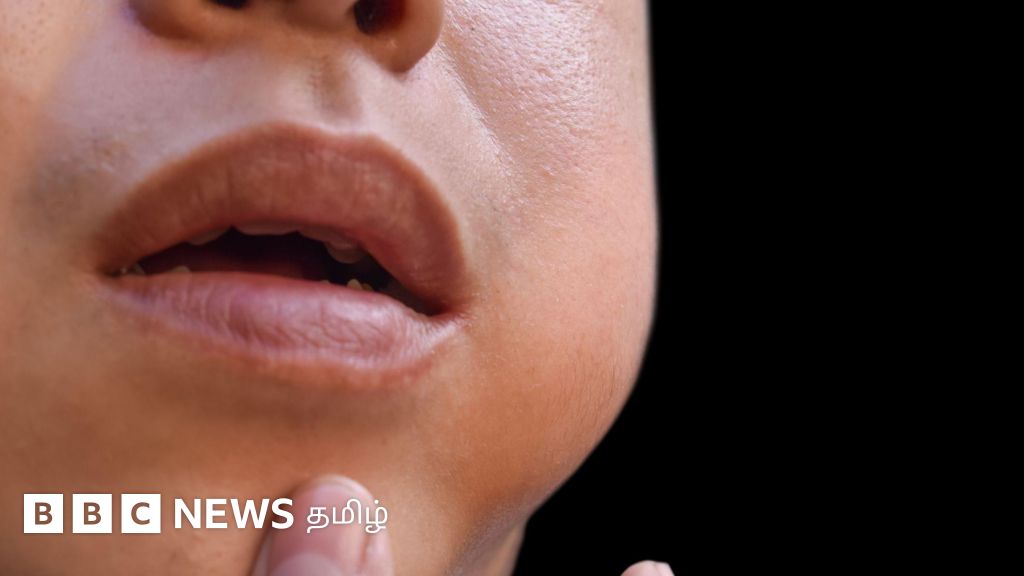 பொன்னுக்கு வீங்கி: தமிழ்நாட்டில் அதிகரித்து வரும் நோய்க்கு அரசு தடுப்பூசி வழங்காதது ஏன்?