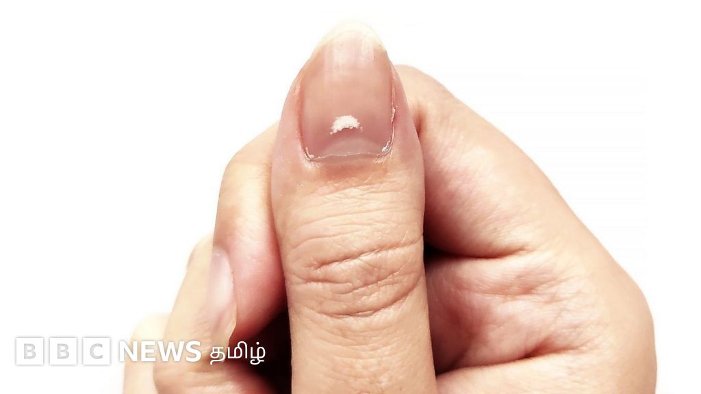 விரல் நகங்களின் நிறம், வடிவம் மாறுவது உடல்நலக் கோளாறின் வெளிப்பாடா? வெள்ளை நிற கோடு எதை குறிக்கிறது?
