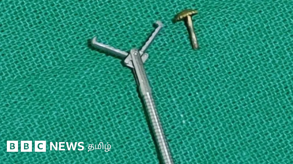 மூச்சை இழுக்கும்போது பெண்ணின் மூக்கு வழியாக நுரையீரலுக்குள் சென்ற மூக்குத்தி - என்ன ஆனது?