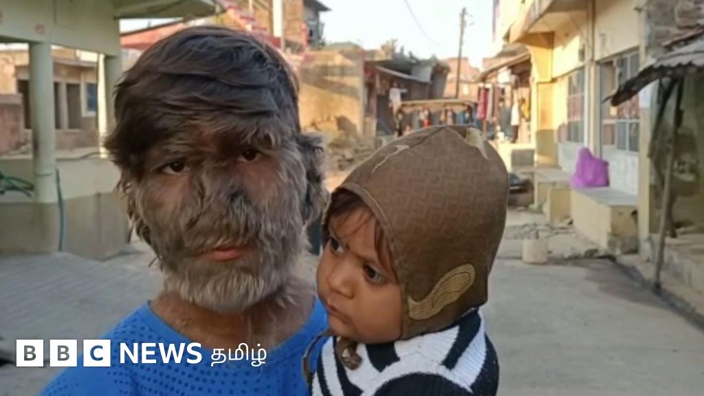 ஓநாய்-மனித நோயால் பாதிக்கப்பட்ட 17 வயது மாணவர் - இந்த நோய் ஏற்பட என்ன காரணம்?