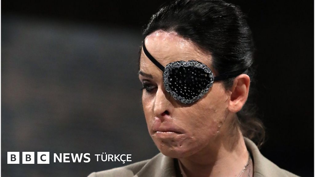 İtalya'da eski Miss İtalya finalisti sevgilisine asitle saldıran erkeğe 15 yıl hapis