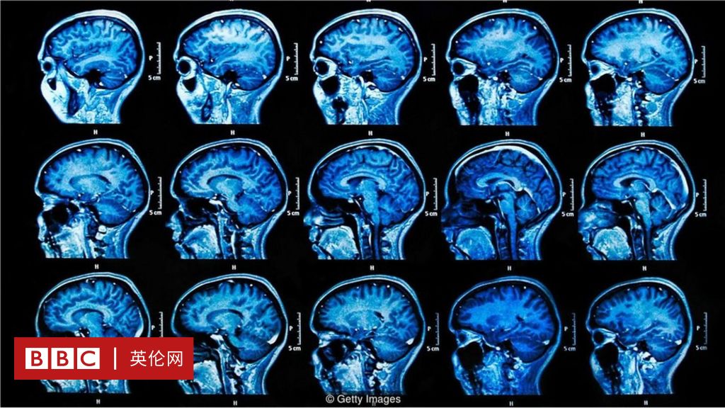 疱疹导致老年痴呆——证据越来越充足- BBC 英伦网