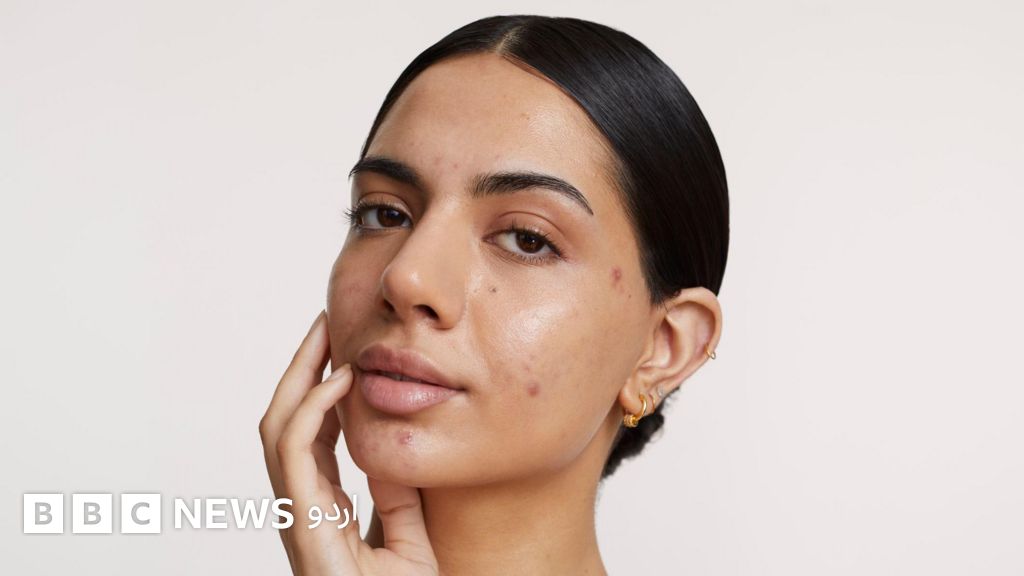 کیا آپ نے کبھی سوچا ہے کہ چہرے پر مہاسوں کا بڑھ جانا، جلد کا خشک اور حساس ہونا، انفیکشن کے خطرے میں اضافہ اور ایگزیما، سورائسس جیسی بیماریاں ٹینشن سے بھی ہو سکتی ہیں؟