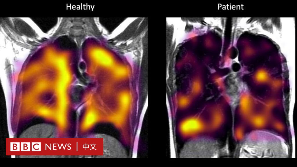 新冠长期症状：新扫描发现患者肺部隐藏损伤