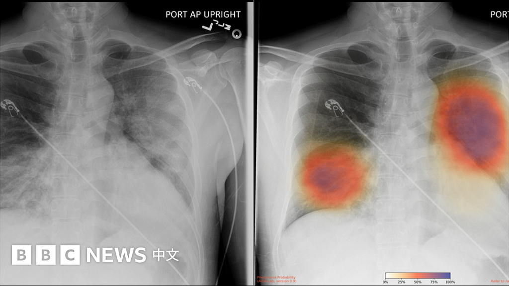 肺炎疫情：人工智能幫助診斷新冠走到哪一步 BBC News 中文