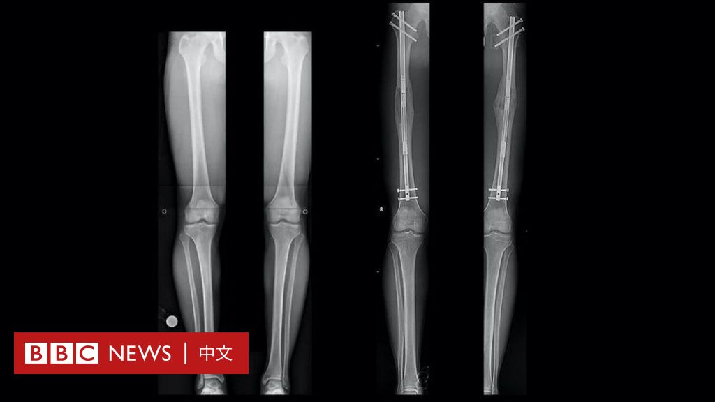 「斷骨增高」手術風險高 專家警告仔細考慮以免後悔 - BBC News 中文