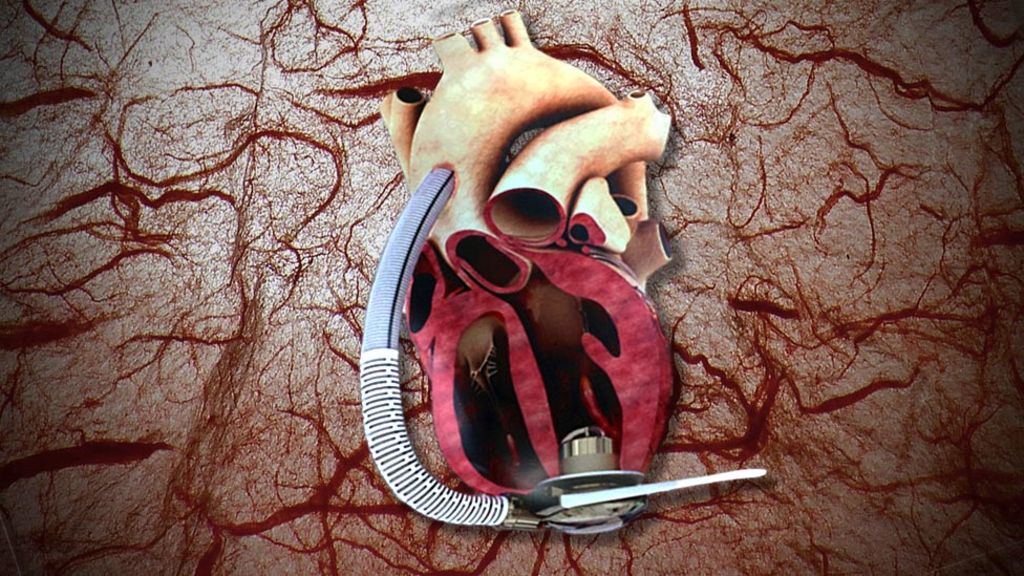 UK's first heart pump targets 2018 clinical trial