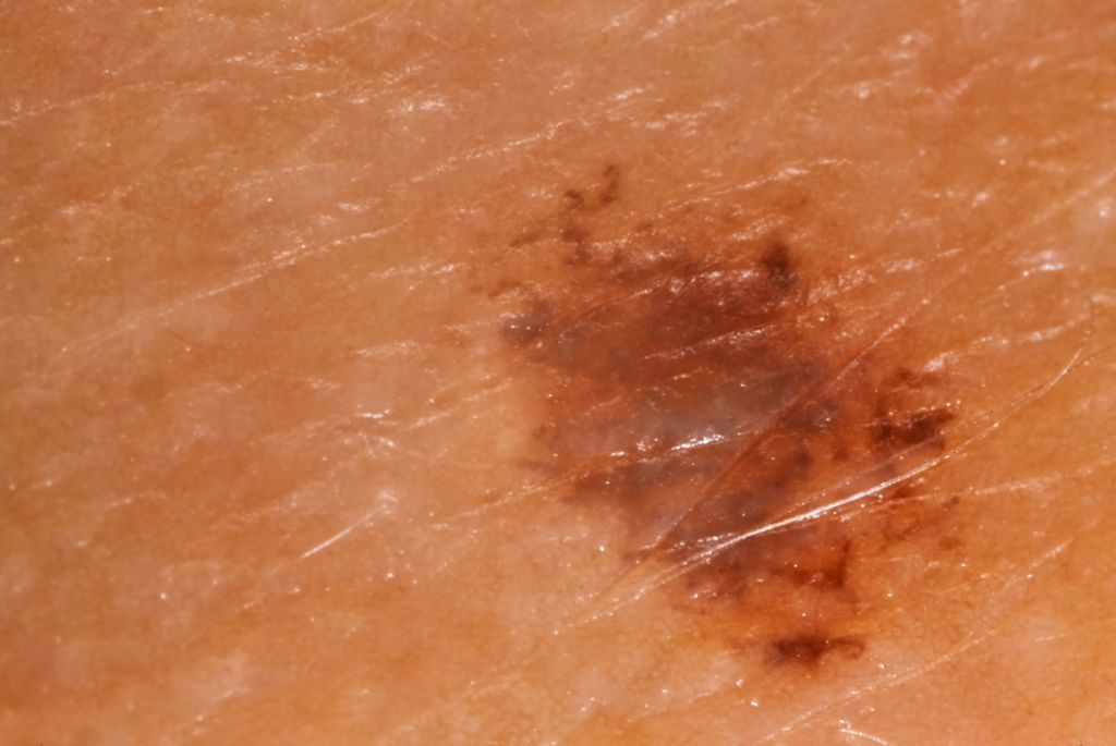 A magnified picture of a skin melanoma. 