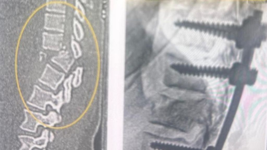 A black and white x-ray image of Johnson's broken spine.