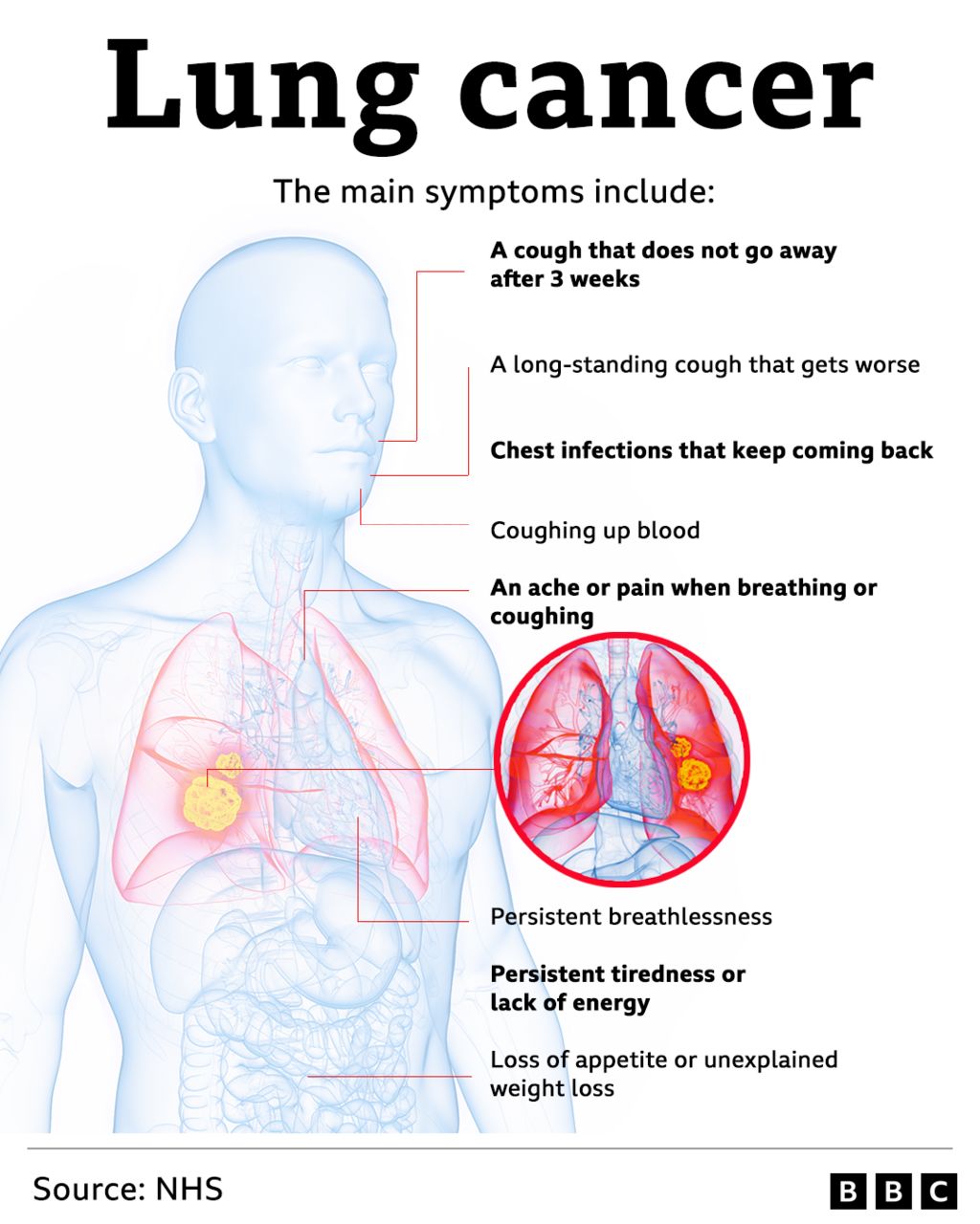 Graphic explains the symptoms of lung cancer including breathlessness, repeated chest infections, a cough that does not go away after 3 weeks