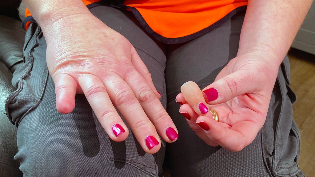 Sarah King's prosthetic little finger