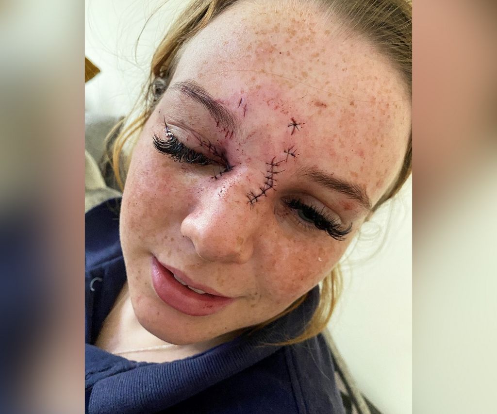 Lily-Blu Whitehurst's facial injuries