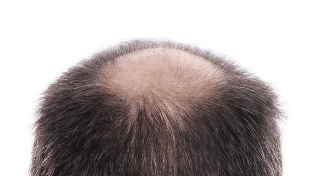 Who, What, Why: Can a bang on the head cause a bald spot? - BBC News