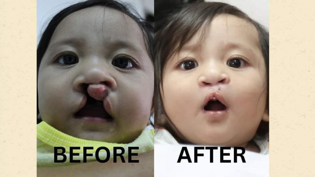 Before and after picture of child with cleft lip