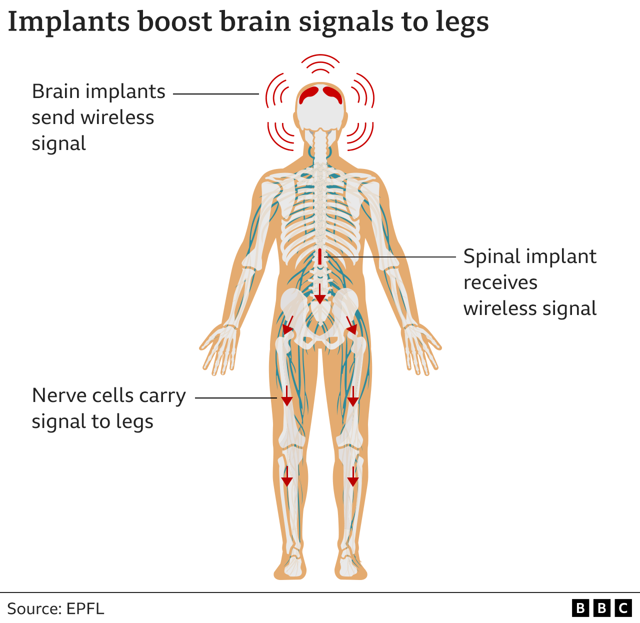 Graphic showing how implants in the brain and spine can help relay a signal to nerve cells in the legs