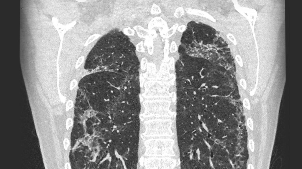 lungs image