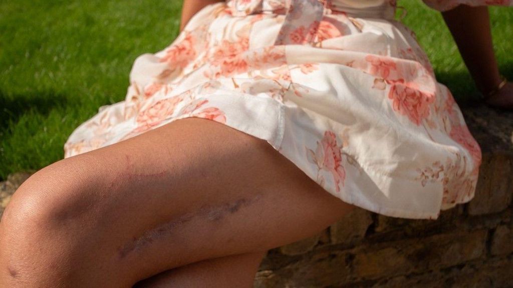 A close-up of the scars on Elaine's left leg.