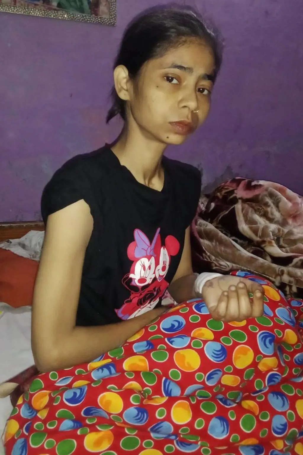 An extremely thin and gaunt-looking woman sits on a bed with a mattress pulled over her legs.