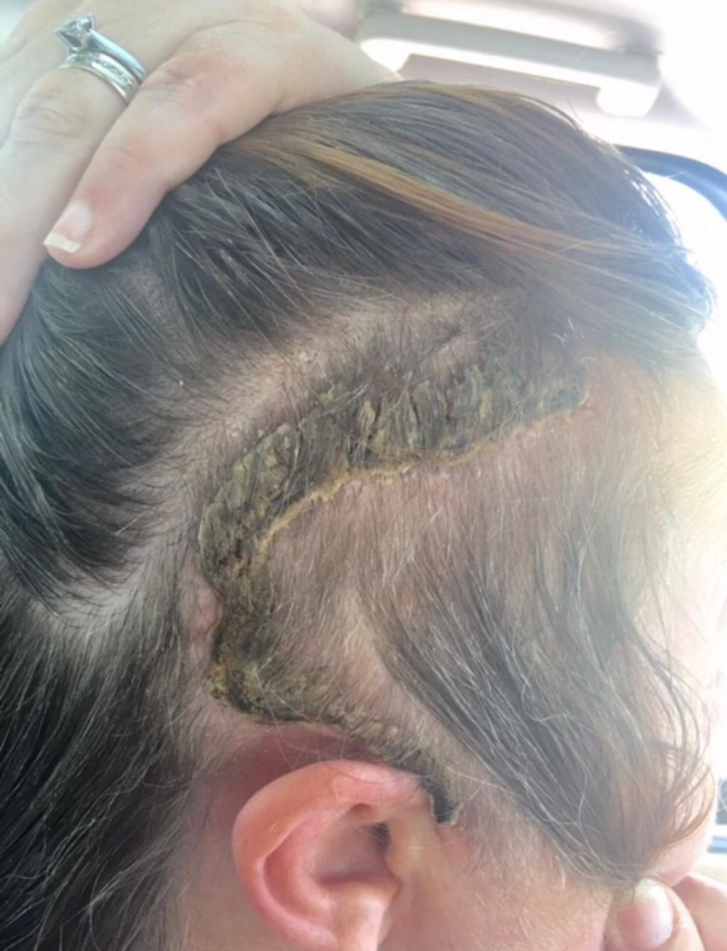 The side of Alex's head above her ear has a C-shaped scar from surgery.