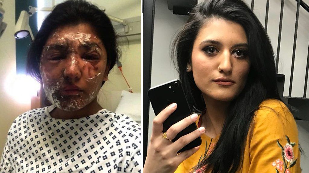Resham Khan, who was left seriously injured after acid was thrown in her face