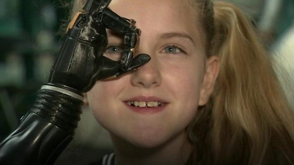 3D printed bionic hands trial begins in Bristol