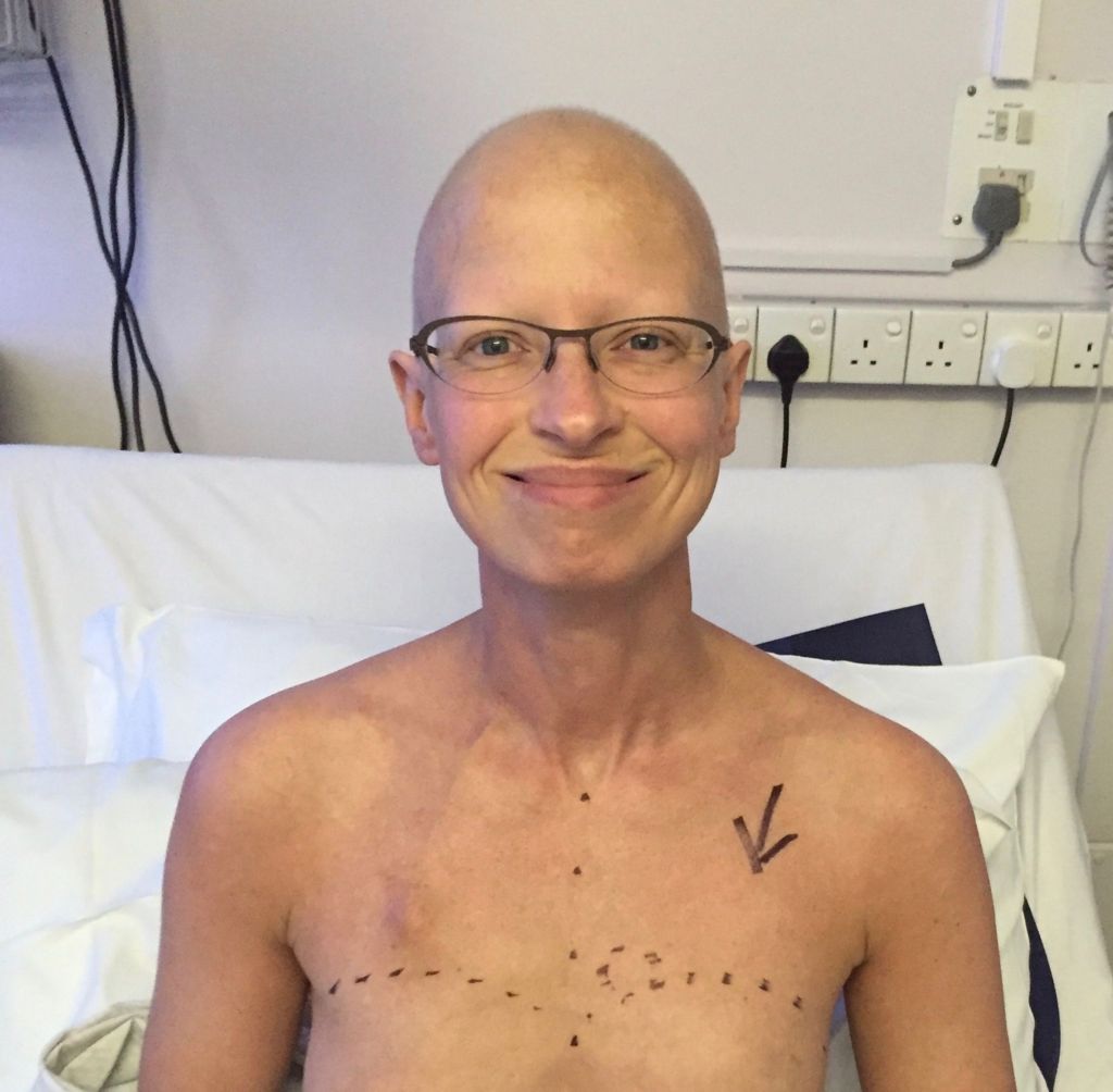 Liz is sat on a hospital bed with black pen on her chest, as guide marks before surgery. She is wearing glasses and has a bald head after chemo.