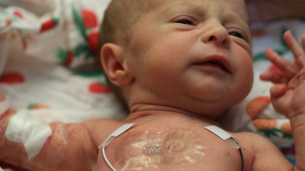 A premature baby with wired monitors and a patch on her chest