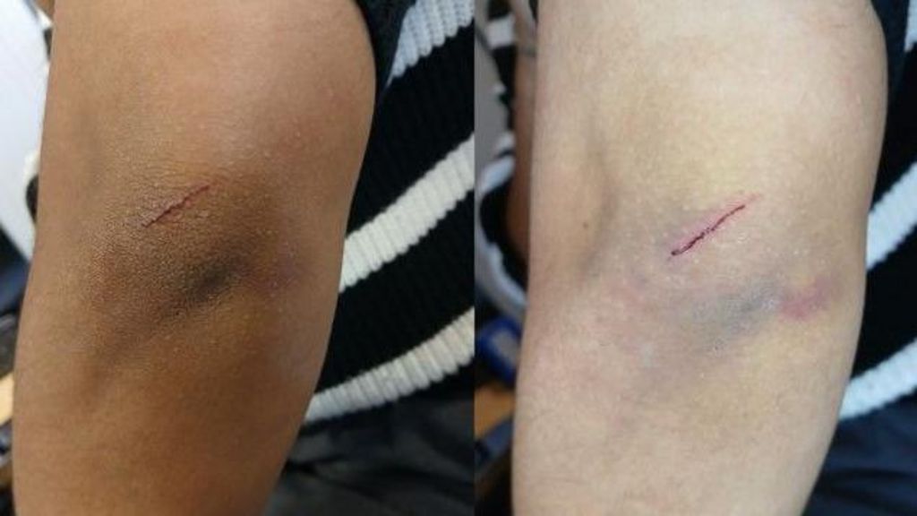 Two pictures side by side of a bruised knee - one picture shows a dark-skinned knee with a slight bruise and the other picture shows how the bruise looks when the device is used, with the bruise showing more clearly.