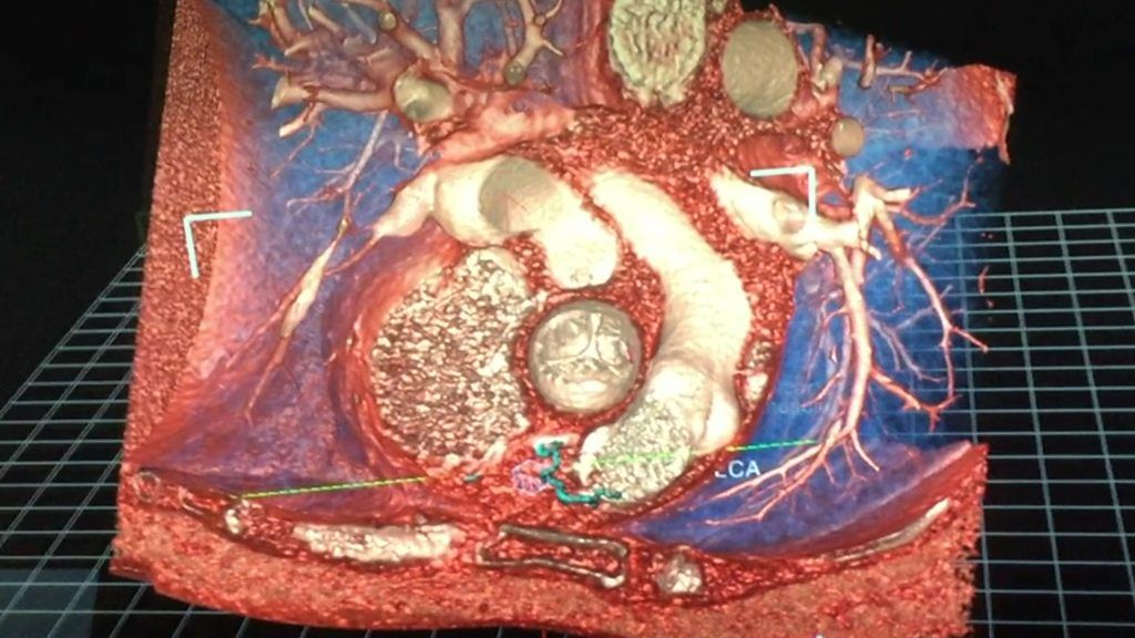 Echopixel - the new 3D image tool for surgeons