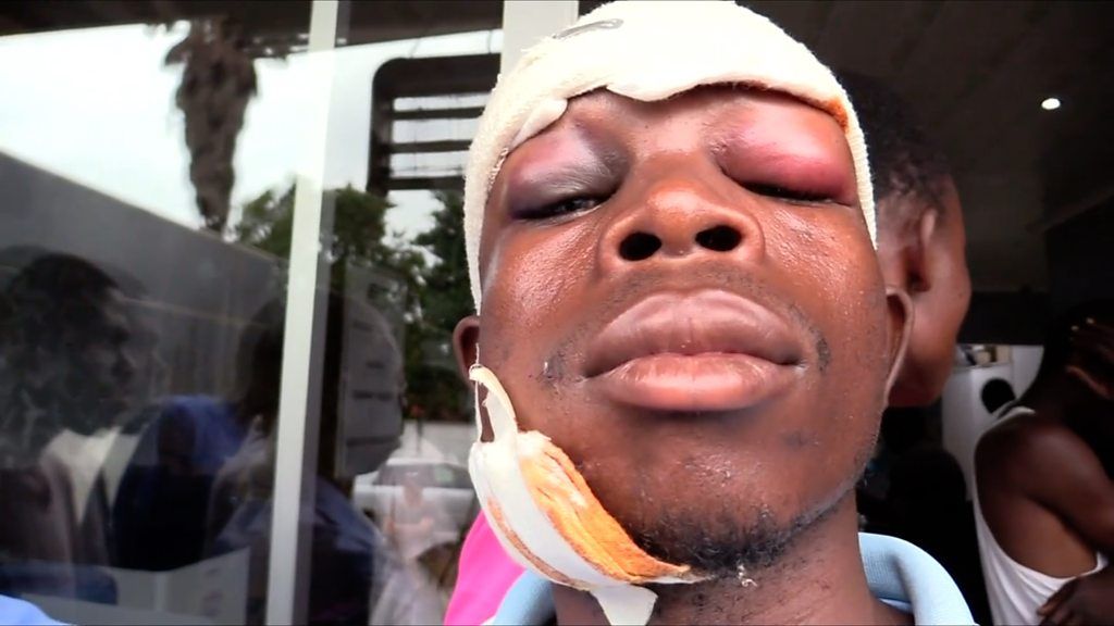 An alleged victim of security forces crackdown in Zimbabwe