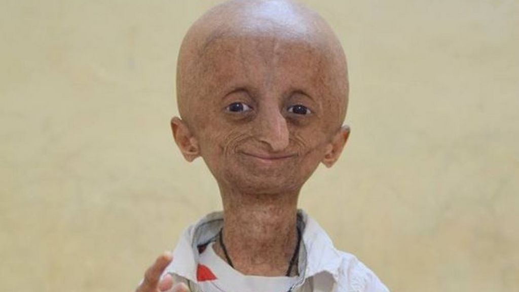 Nihal Bitla: India progeria campaigner dies aged 15 - BBC News