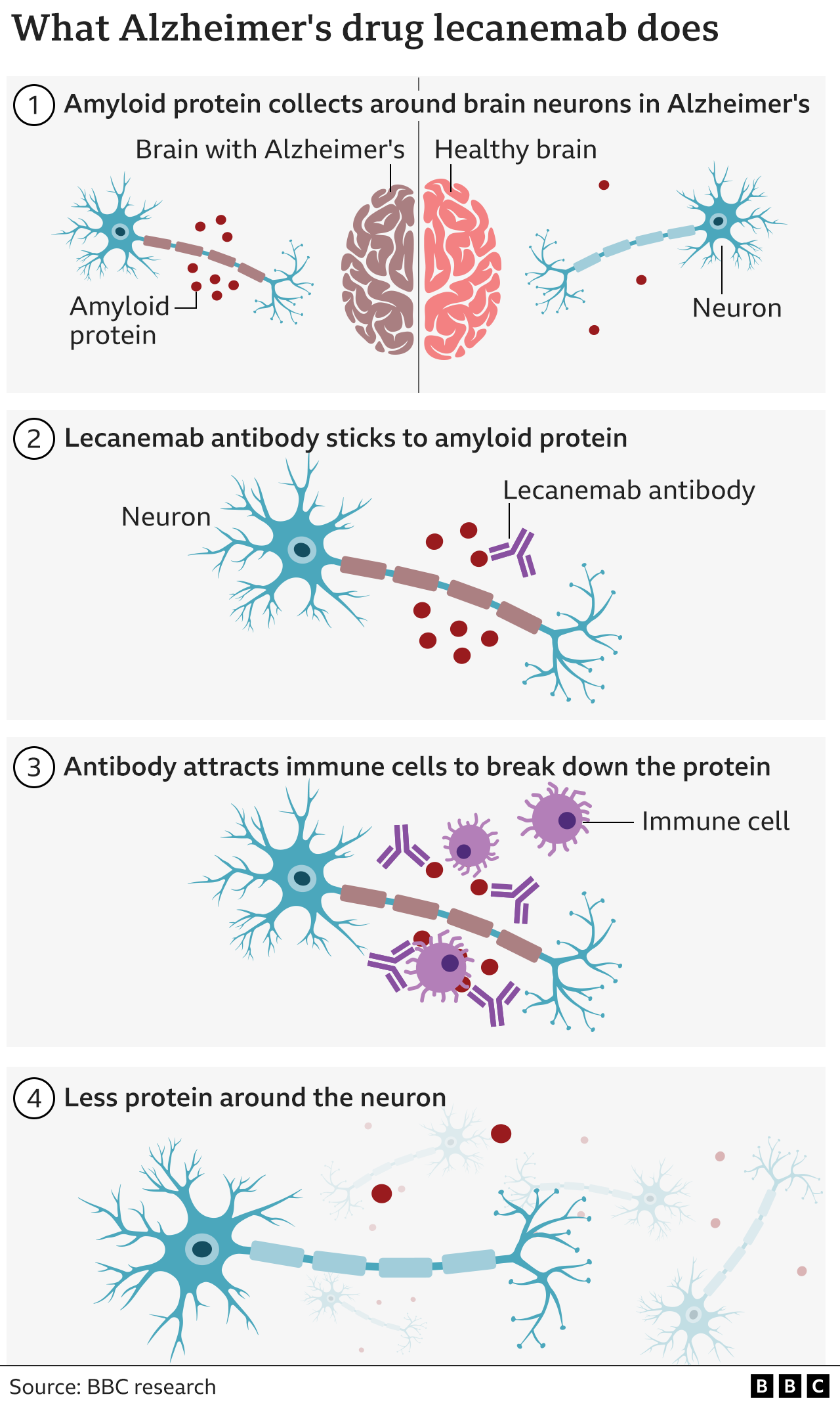 Графика, показывающая, что делает антитело к леканемабу — прикрепляется к амелоидным белкам, которых больше в мозге, пораженном болезнью Альцгеймера, чем в здоровом мозге, а затем привлекает иммунные клетки организма, которые расщепляют белок