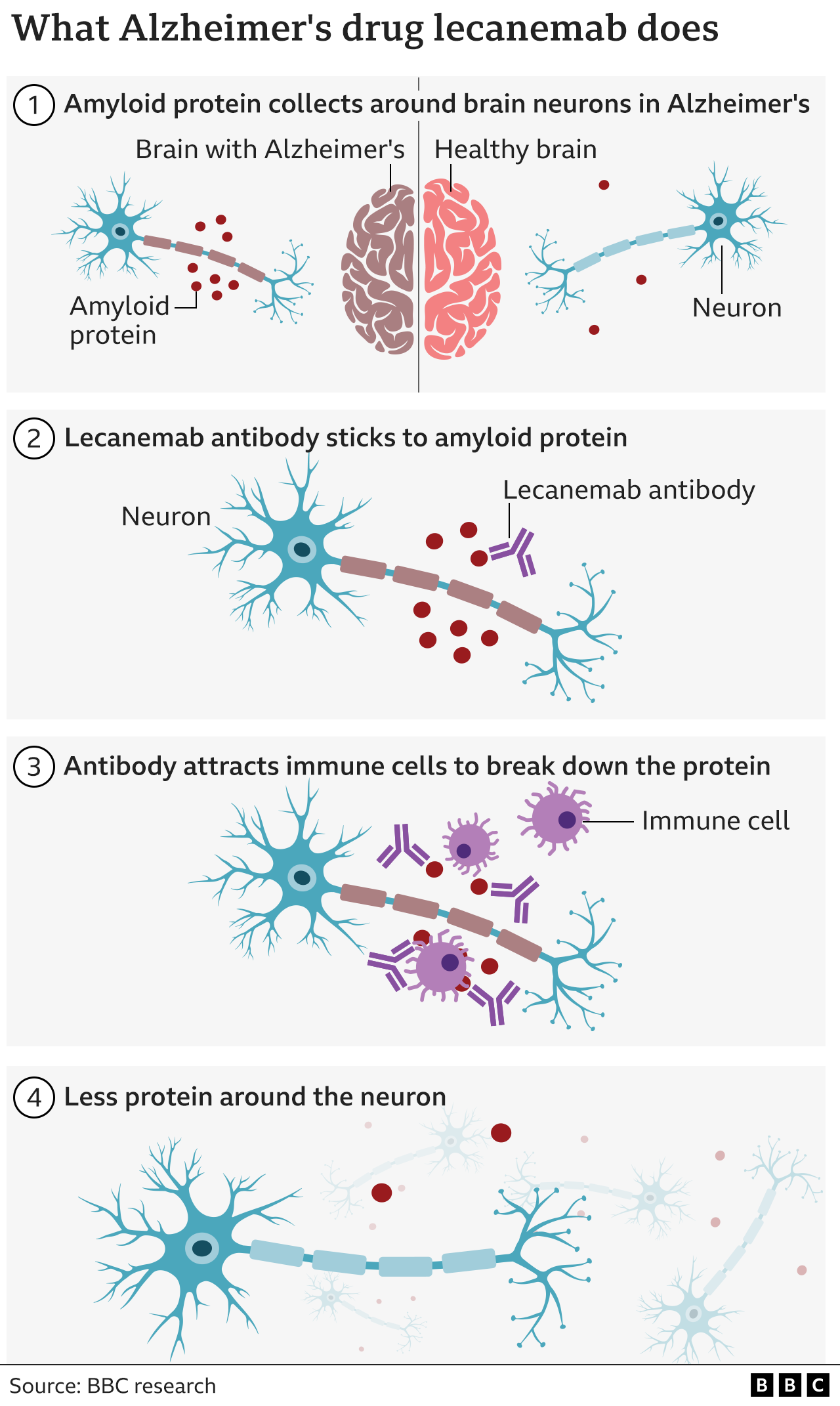 Gráfico que muestra lo que hace el anticuerpo lecanemab: se adhiere a las proteínas ameloides, más presentes en los cerebros afectados por el Alzheimer que en los sanos, y atrae a las células inmunitarias del organismo, que descomponen la proteína