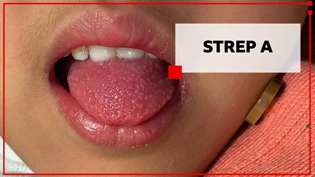 A child's tongue with "Strep A"