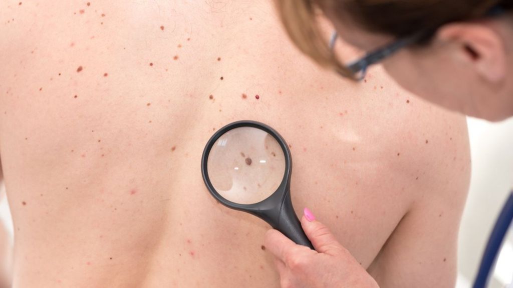 Tratamentos para câncer de pele melanoma