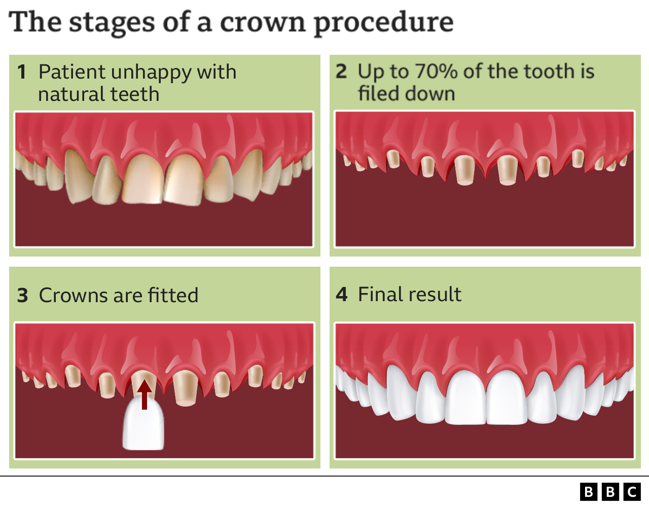 The stages of a crown procedure - 1 Patient unhappy with natural teeth; 2 Up to 70% of the tooth is filed down; 3 Crowns are fitted; 4 Final result