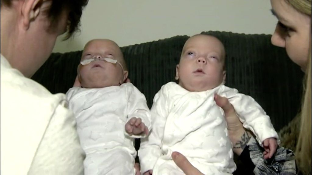 Teddy and Ronnie were born with Twin to Twin Transfusion Syndrome