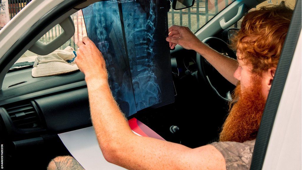 Russ Cook examines a scan on his back injury