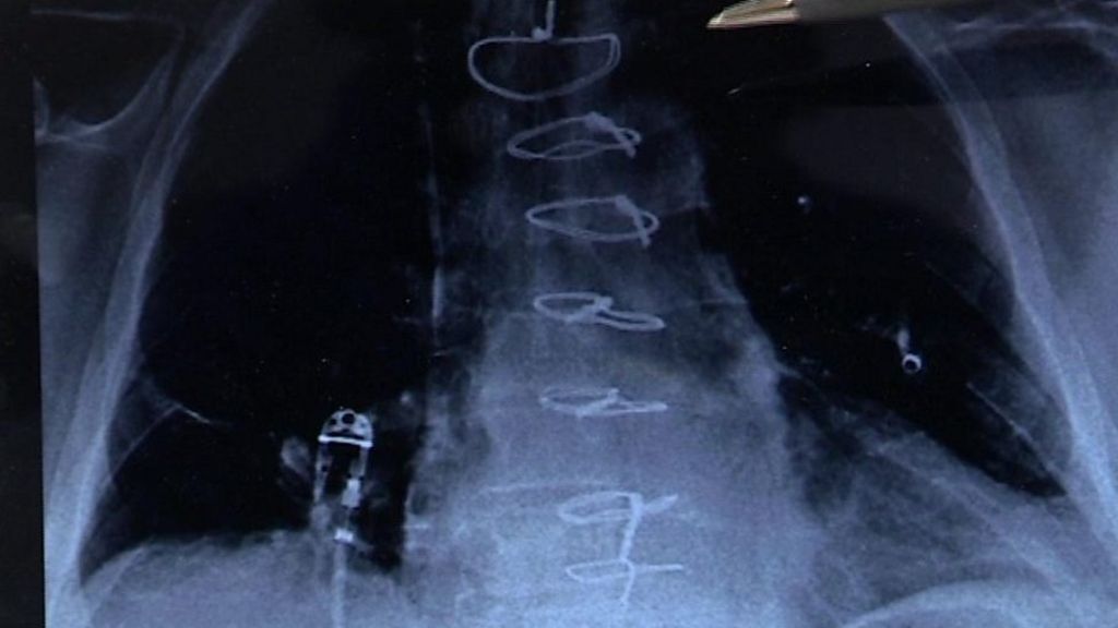 Sixteen-year-old's revolutionary heart surgery idea