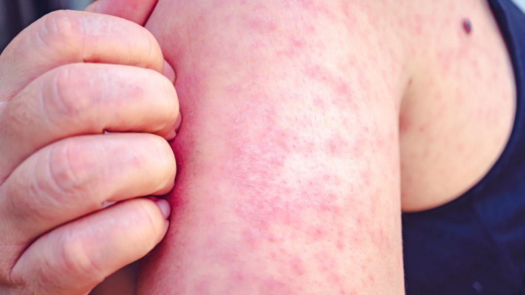 A woman with a rash caused by measles