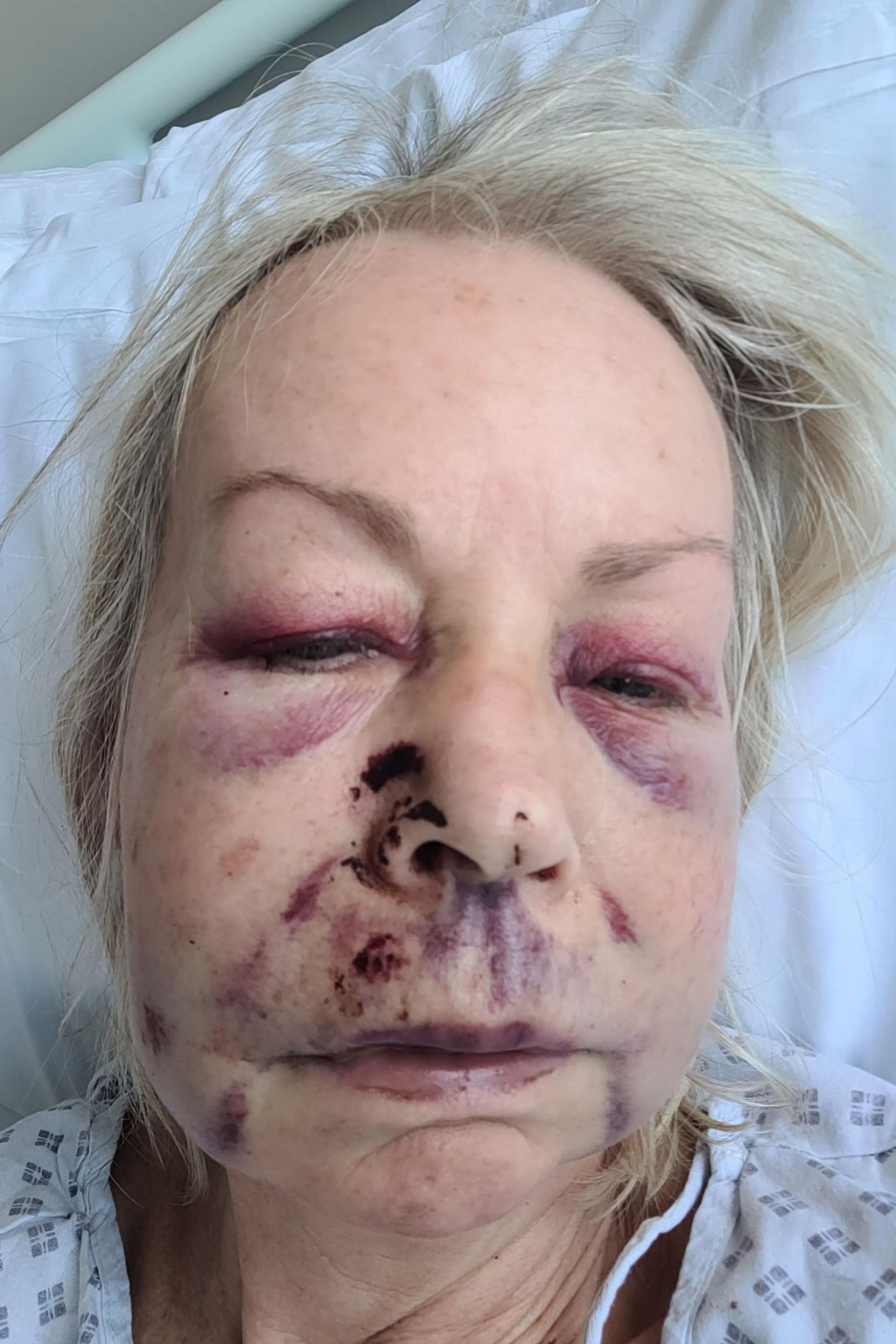 A woman with a swollen face