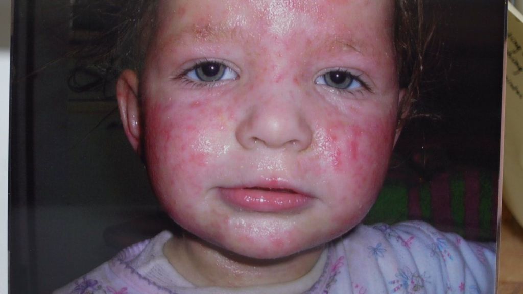 Poppy when she was a young child with severe eczema across the face.