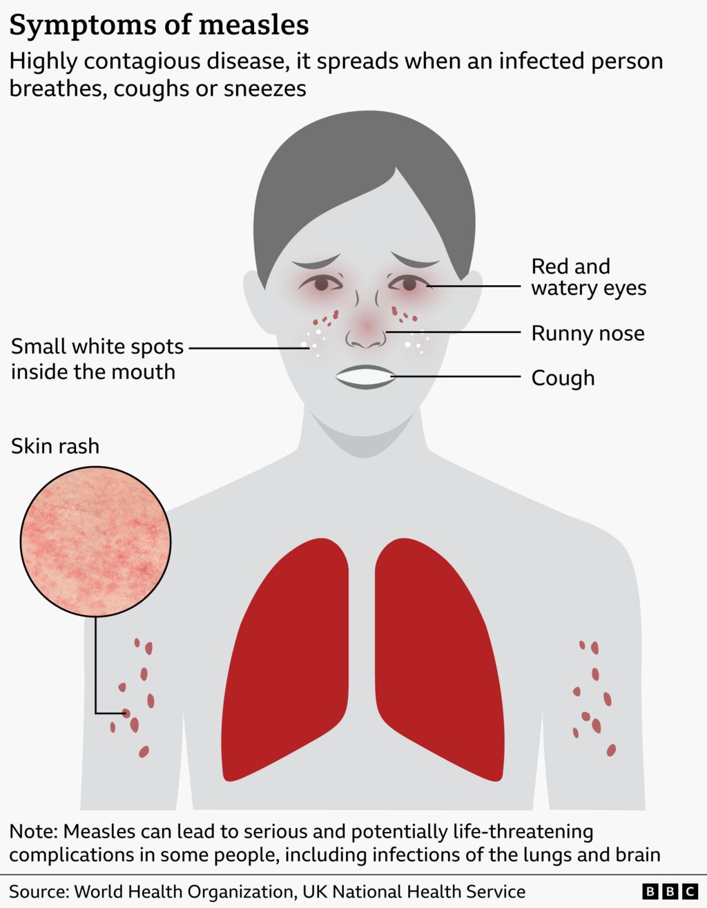 Graphic shows symptoms of measles, such as red and watery eyes, cough, runny nose, small white spots inside the mouth and skin rash in various parts of the body. Text says that measles is a highly contagious disease, that spreads when an infected person breathes, coughs, or sneezes. A note says that measles can lead to serious and potentially life-threatening complications in some people, including infections of the lungs and brain. Source: World Health Organization and UK National Health Service