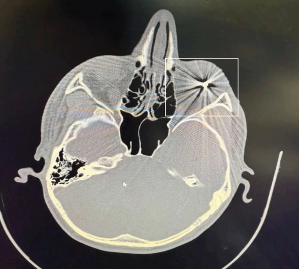 An exclusive CT-scan image obtained by BBC News Persian shows a metal pellet embedded in a Mashad protester's right eyeball.