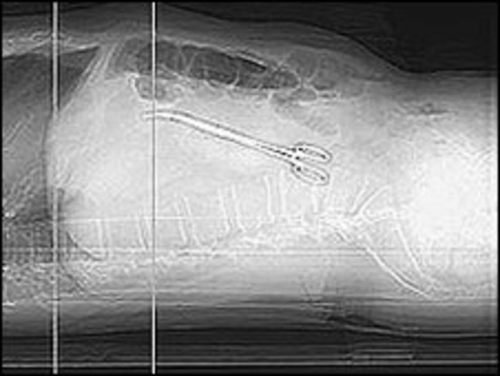 Surgical instruments 'left inside' patients BBC News