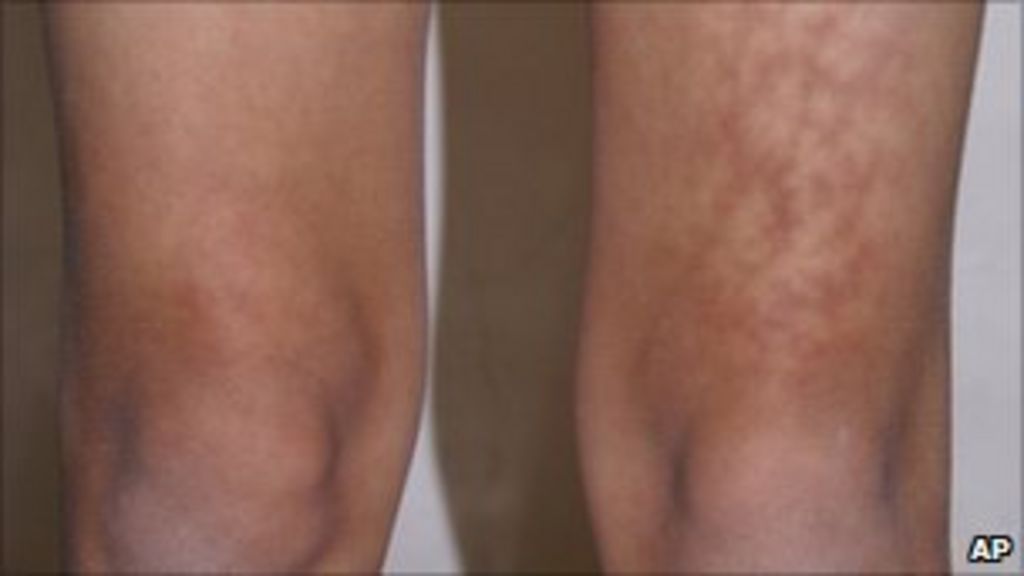 laptop-thigh-skin-rash-warning-bbc-news