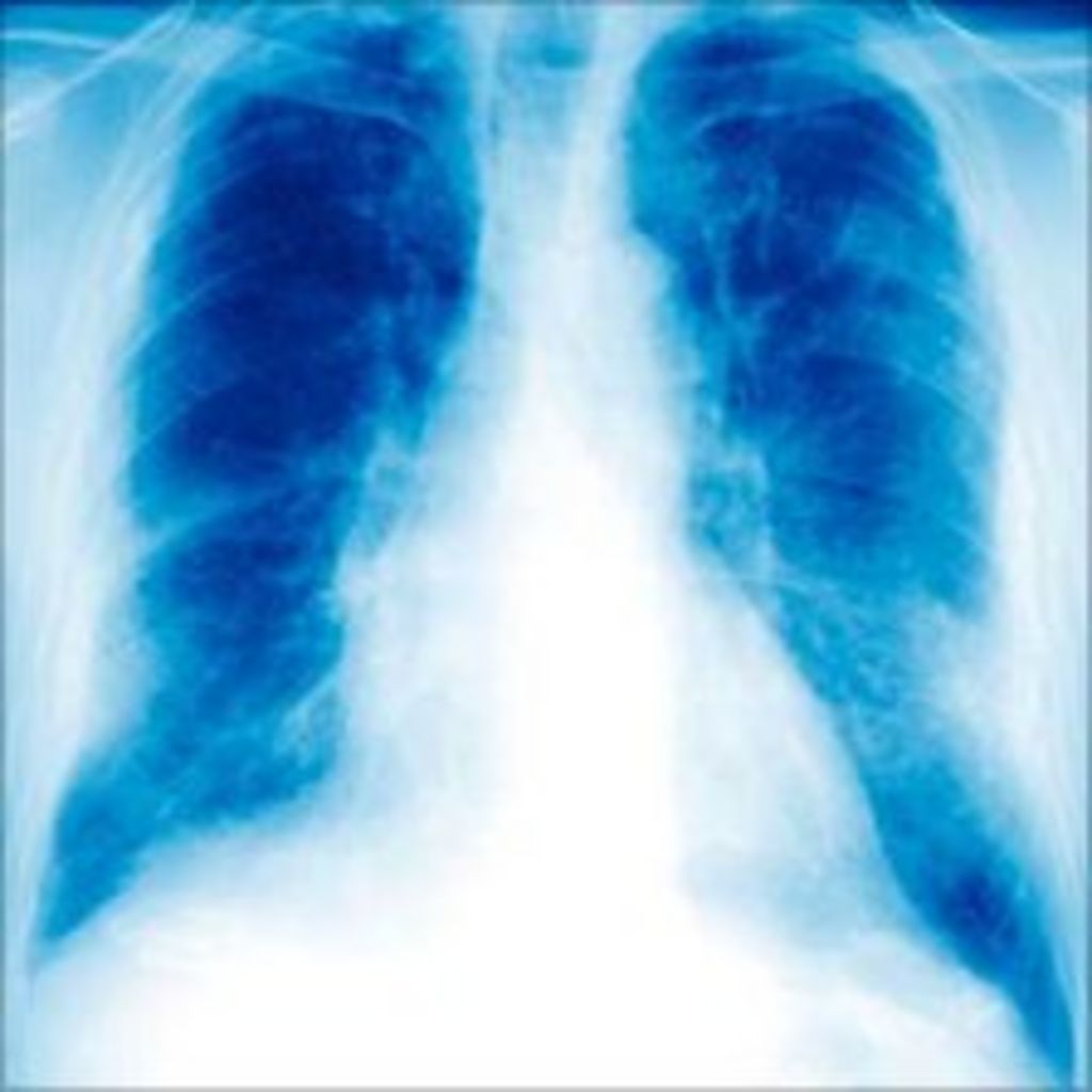Mesothelioma asbestos victims to get £350m compensation BBC News Mesothelioma asbestos victims to get £350m compensation BBC News