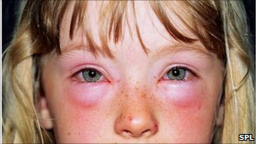 Alternative allergy test offers 'mislead parents' BBC News